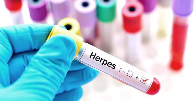 Herpes Genital Penyakit Menular Seksual yang Perlu Diwaspadai